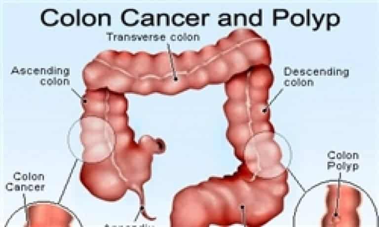 افزایش سرطان روده بزرگ در گیلان