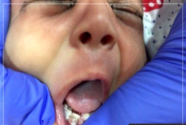 پزشکان هفت دندان نوزاد یک ماهه را کشیدند