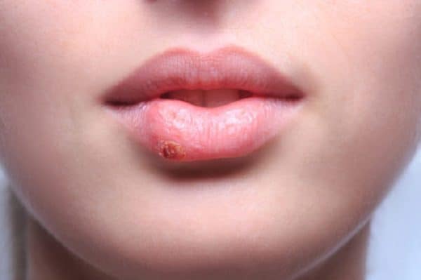 تبخال - تبخال بیماری ویروسی، بی‌خطر و خودبخود بهبود یابنده است - ایسنا