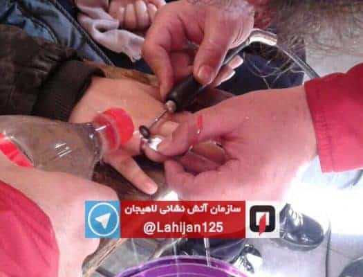 رها شدن بانوی جوان لاهیجانی از شر انگشتر دردسر ساز - رها شدن بانوی جوان لاهیجانی از شر انگشتر دردسر ساز! - انگشتر