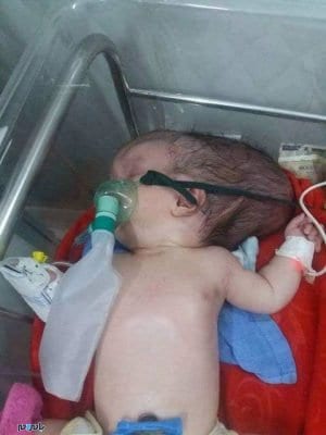 تولد نوزادی با نصف جمجمه 2 - تولد نوزادی با نصف جمجمه + تصاویر - تولد نوزاد