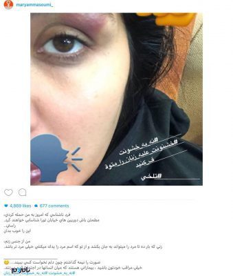 مریم معصومی - چهره کبود بازیگر زن ایرانی | حمله فیزیکی به مریم معصومی + عکس - بازیگر