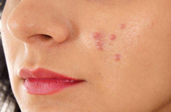 جوش صورت - جوش زدن هر ناحیه از صورت نشانه چه بیماری است؟ - جوش