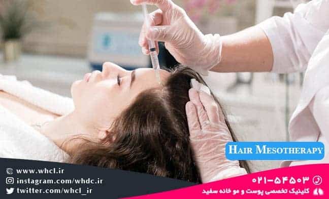 hair mesotheapy - راه‌های واقعاً موثر برای درمان و جلوگیری از ریزش مو - جلوگیری از ریزش مو