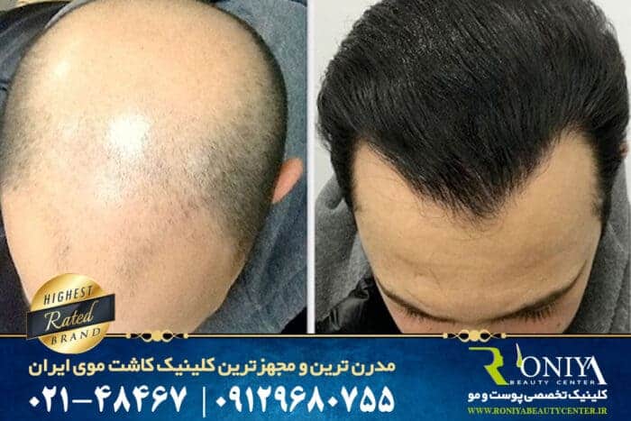 growth after transplant - کاشت مو انجام بدیم یا خیر ؟ - SUPER FUE
