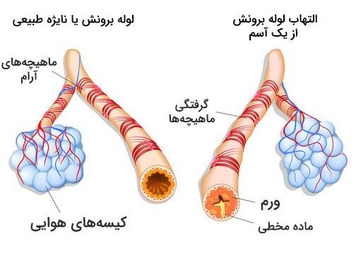 آسم 1 - درمان تضمینی آسم در خانه - تزریق سرم در منزل