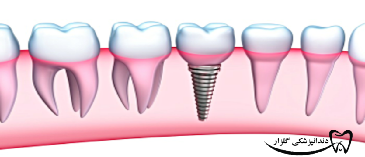ایمپلنت دندان مناسب چه کسانی است؟