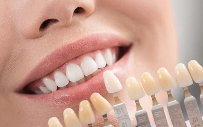 5646 700x438 - قیمت لمینت دندان در تهران چقدر است؟