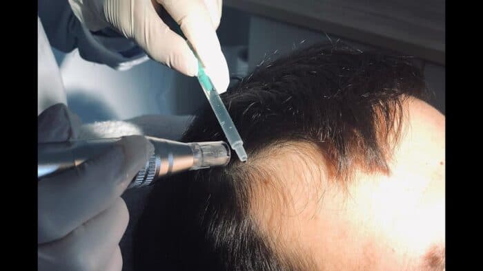 رشد مو - آیا مزو رویتاکیر از سفید شدن مو هم جلوگیری می‌کند؟ - درمان ریزش مو