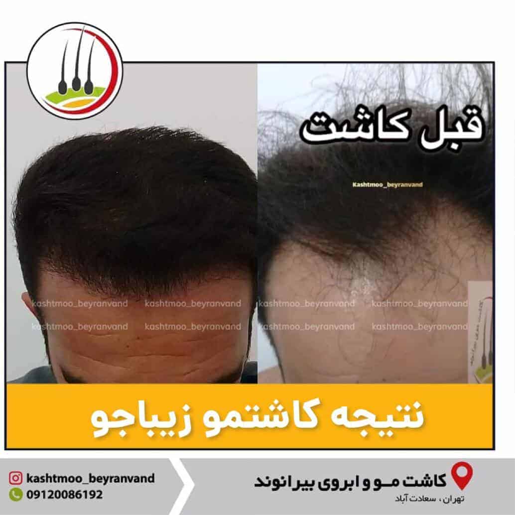 هر آنچه در مورد کاشت مو باید بدانیم
