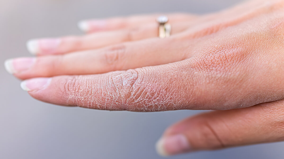 word image 207056 1 scaled - پوست پوست شدن دست به چه علت است؟ درمان آن را یاد بگیرید - پوست پوست شدن دست