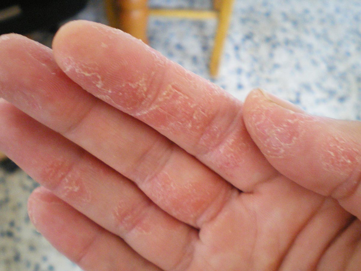 word image 207056 2 - پوست پوست شدن دست به چه علت است؟ درمان آن را یاد بگیرید - پوست پوست شدن دست