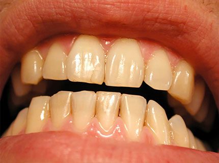 images 1674240954 - علت زردشدن دندان و روش‌های سفیدکردن آن‌ها -