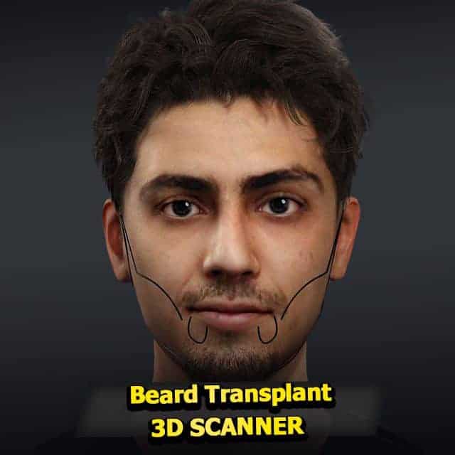 کاشت مو تحت پوشش بیمه است