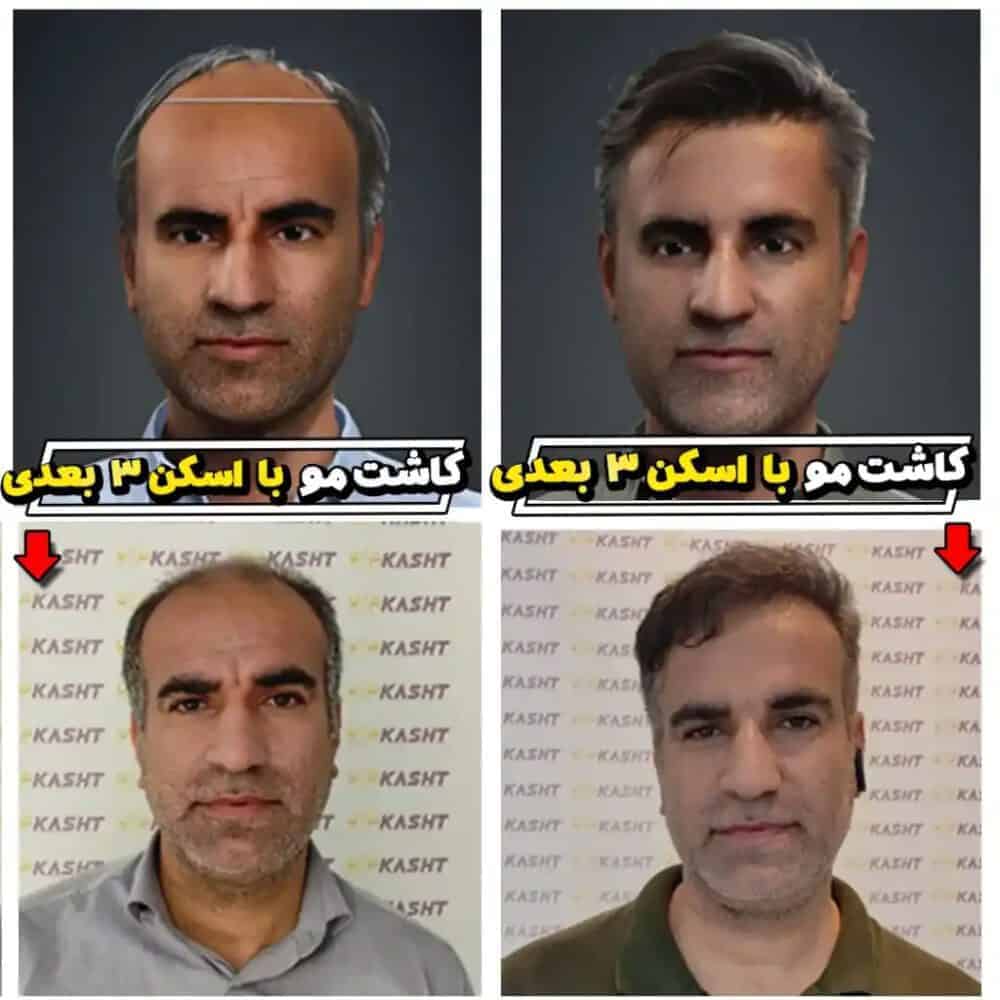 word image 215981 3 - کاشت مو تحت پوشش بیمه است -