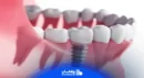 هزینه ایمپلنت | قیمت ایملپنت دندان ۱۴۰۲