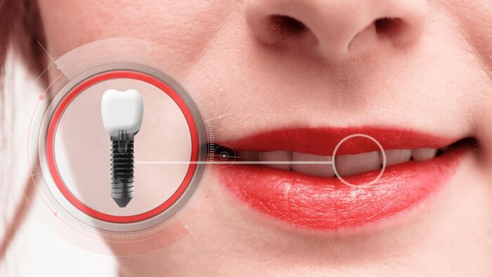 images 1686130603 64804fab7ec59 - قیمت ایمپلنت دندان در کشورهای مختلف - ایمپلنت