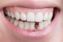 قیمت ایمپلنت دندان در کشورهای مختلف چقدر است؟