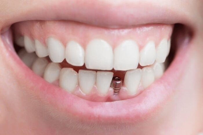 images 1686136212 6480659494269 - قیمت ایمپلنت دندان در کشورهای مختلف چقدر است؟ -