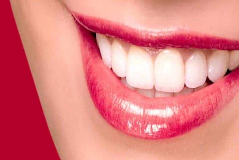 بهترین مارک و نوع لمینت دندان