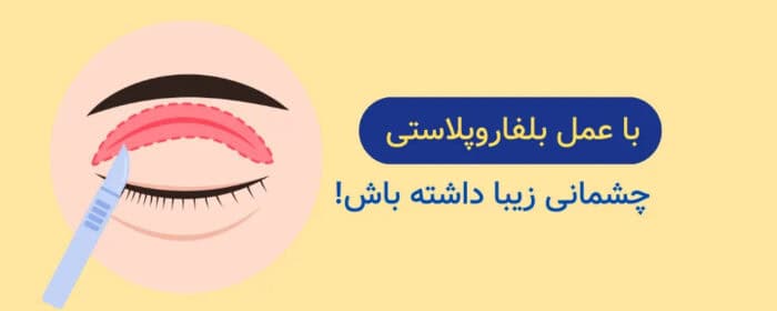 8d788cee 3a98 4252 8195 03e03c5c4afc - بعد از عمل بلفاروپلاستی چه بخوریم - بعد از بلفاروپلاستی چه بخوریم