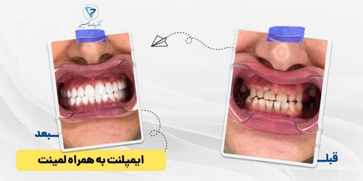 word image 269955 2 scaled - ایمپلنت دیجیتال چیست و چه کاربردی دارد - ایمپلنت دیجیتال