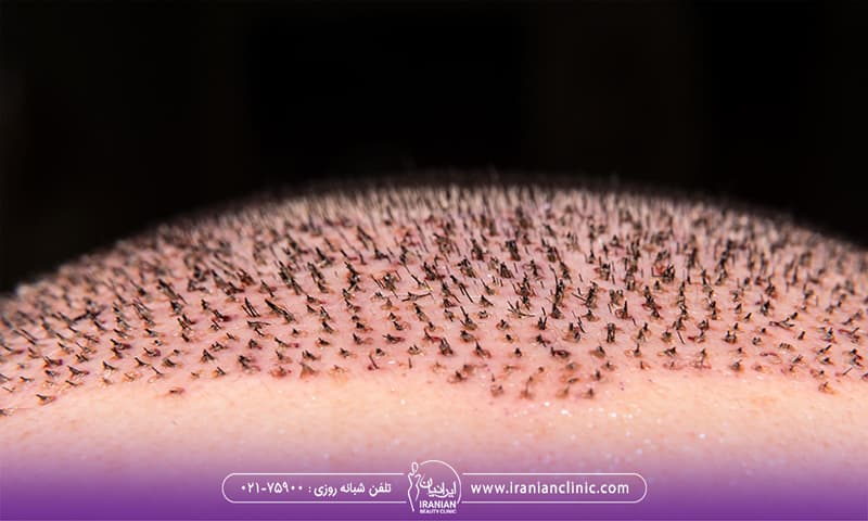 آیا نور آفتاب بعد از کاشت مو مضر است؟