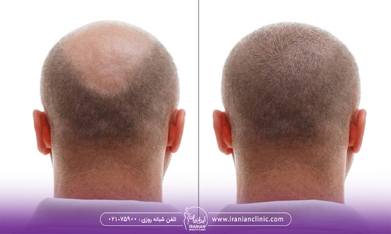 word image 272049 3 - آیا نور آفتاب بعد از کاشت مو مضر است؟ - کاشت مو
