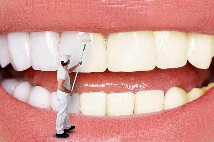 edgKU7Asg4qM - کامپوزیت دندان برای شما مناسب تر است یا بلیچینگ دندان؟ - بلیچینگ دندان