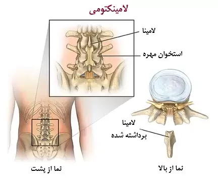 جراحی لامینکتومی و اولین بار در ایران – دکتر بابک سیف زاده