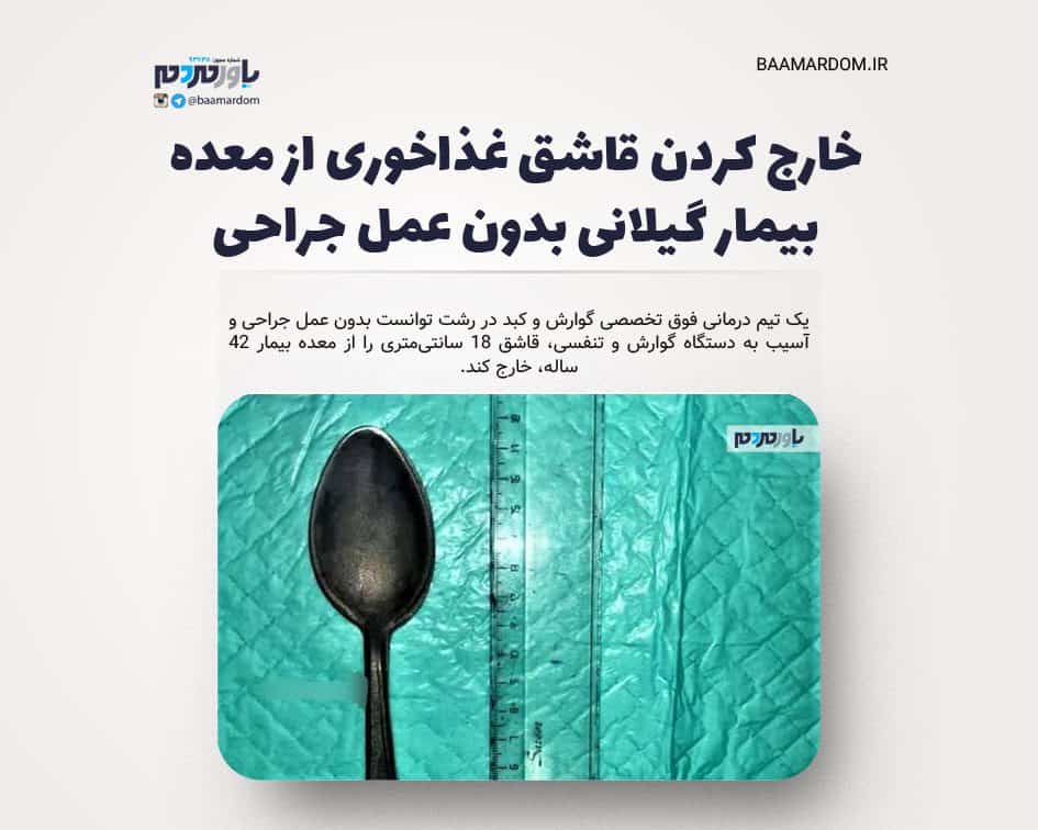 خارج کردن قاشق غذاخوری از معده بیمار گیلانی بدون عمل جراحی