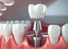 بهترین کلینیک دندانپزشکی برای ایمپلنت در مشهد