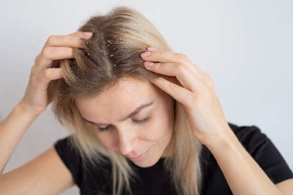 علت خارش سر و ریزش مو در زنان چیست؟