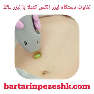 تفاوت دستگاه لیزر الکس کندلا با لیزر IPL