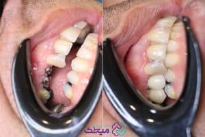طول عمر ایمپلنت