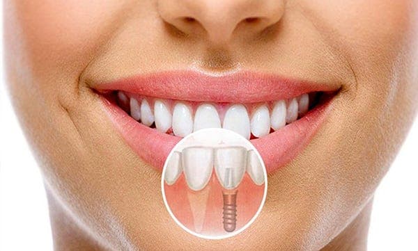 word image 297763 3 - انواع روش‌های کاشت ایمپلنت دندان را بشناسیم - اوردنچر