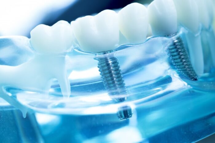 Dental Implant 4 1596473118 18130 - ایمپلنت دیجیتال و نقش آن در تحولات دندانپزشکی -