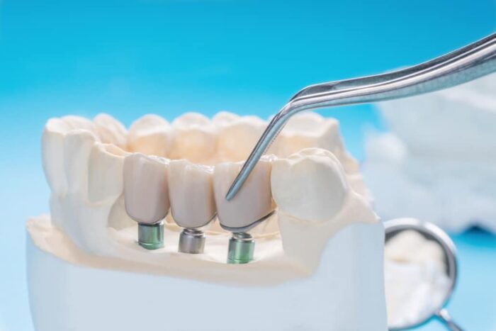 close up implan model tooth support fix bridge implan crown 1030x687 1 - ایمپلنت دیجیتال و نقش آن در تحولات دندانپزشکی -