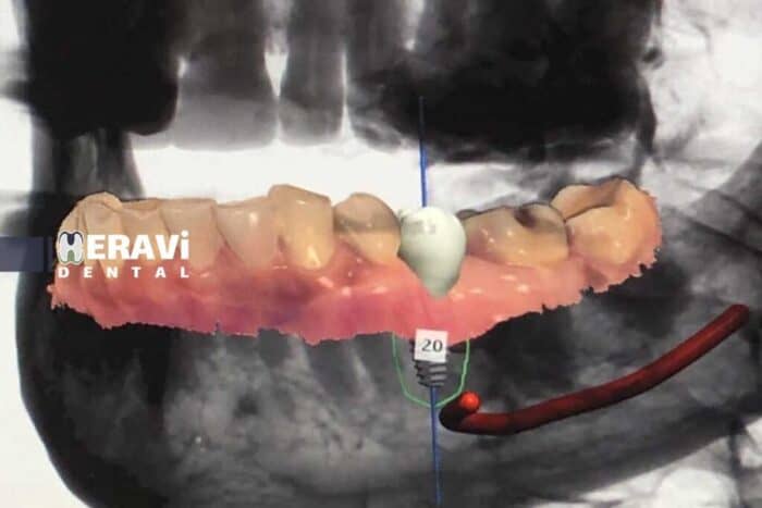 Digital or traditional implantsj3 1024x683 1 - راهنمای جامع ایمپلنت دندان: از تکنولوژی دیجیتال تا روش‌های سنتی -