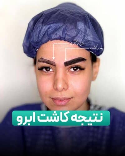 کاشت ابروی طبیعی