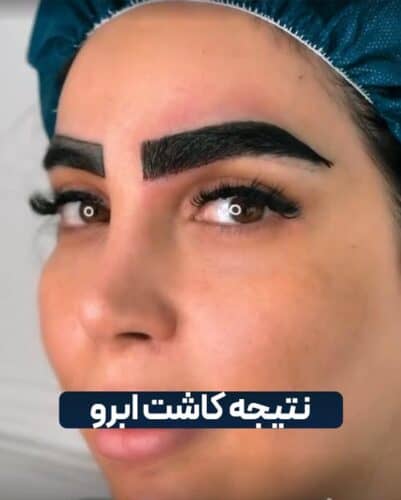 نتیجه کاشت ابروی طبیعی