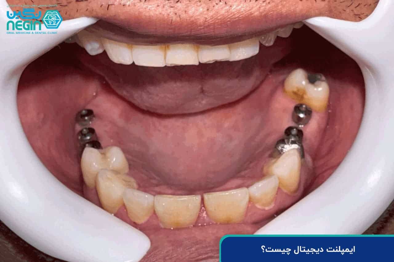 7b8cbb27 ba76 40c5 b6b2 edef9848d112 - چرا انتخاب دکتر ایمپلنت دیجیتال در شیراز اهمیت دارد؟ راهنمای کامل بیماران - ایمپلنت
