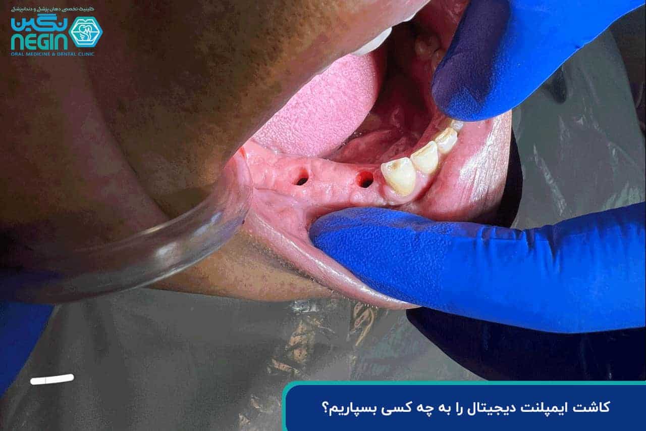 چرا انتخاب دکتر ایمپلنت دیجیتال در شیراز اهمیت دارد؟ راهنمای کامل بیماران